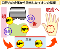 金属アレルギーの順路