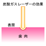 炭酸ガスレーザー照射イメージ