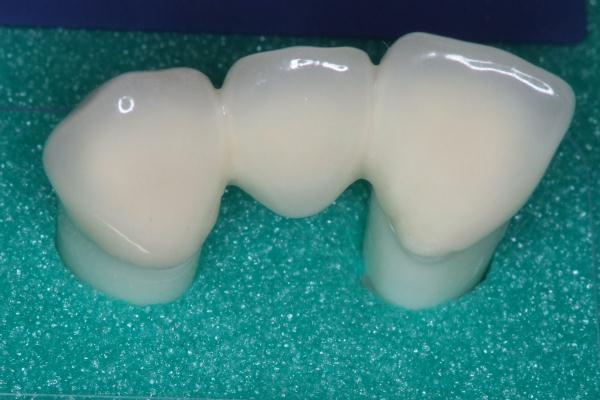 ジルコニア(オールセラミックス)